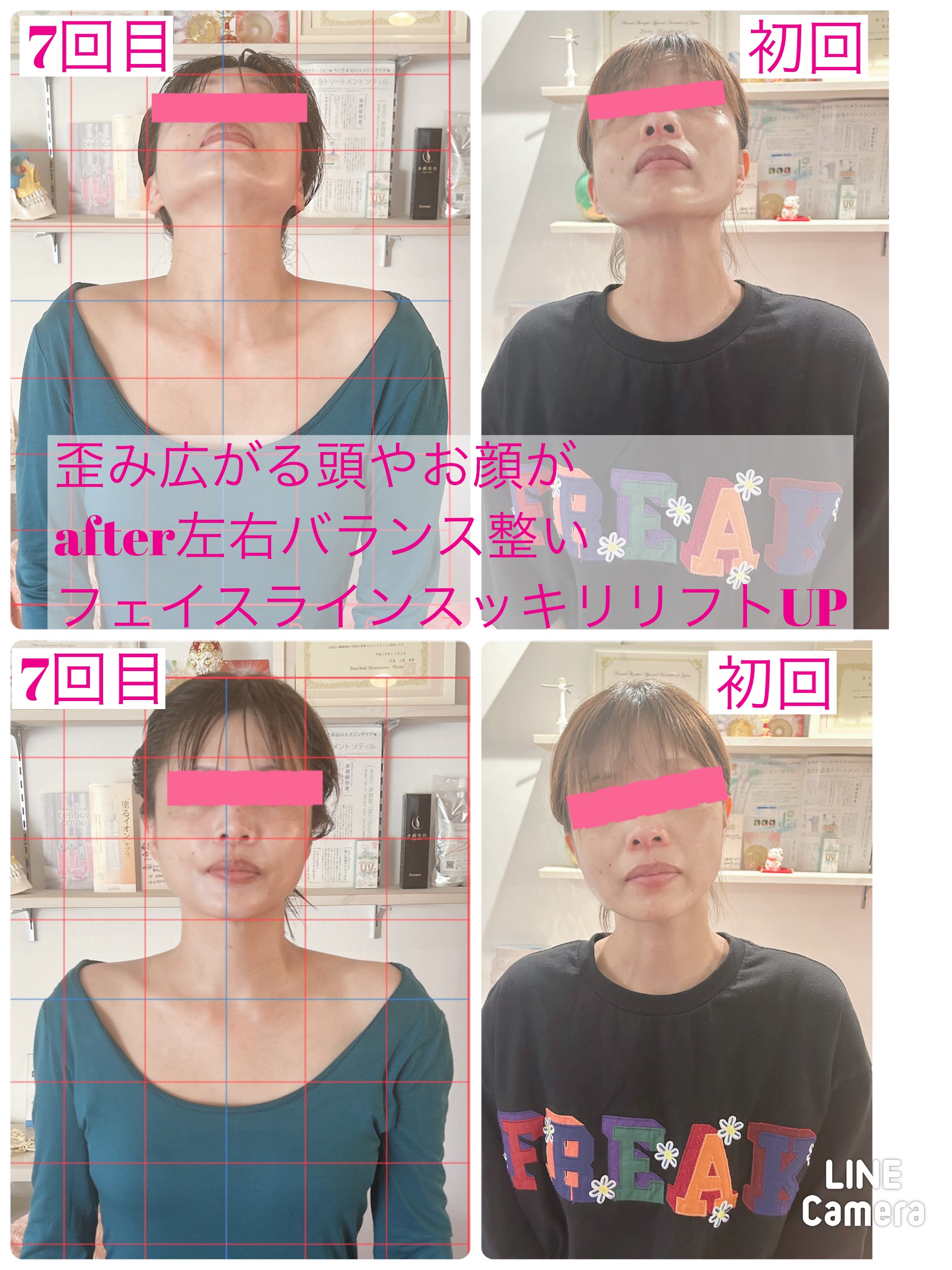 40代後半 福祉施設職員 R．N様頭蓋骨小顔矯正　ビフォーアフタ