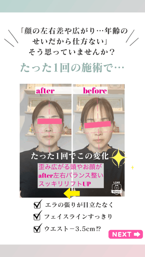たった1回の施術で…「顔の左右差や広がり…年齢のせいだから仕方ない」
そう思っていませんか?